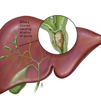 illustration of liver obstructed by gallstones